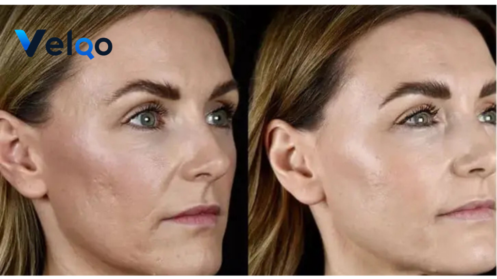 Microneedling Before and After
